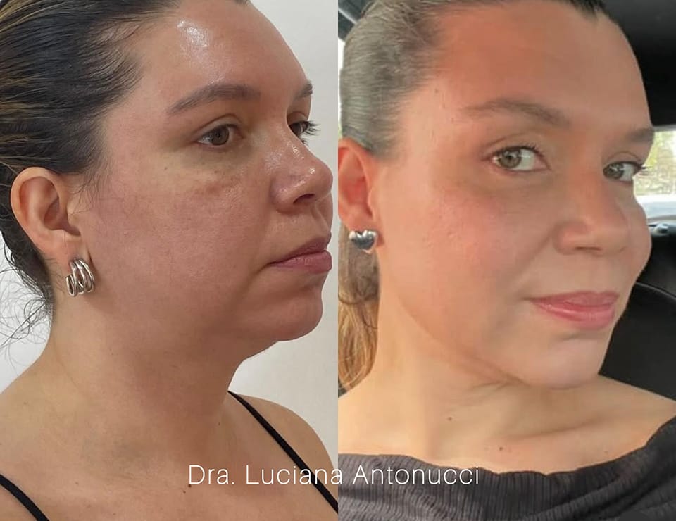 Harmonização Facial 2