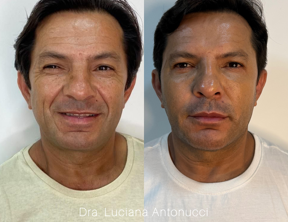 Harmonização facial 1.jpg